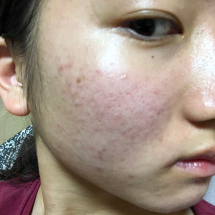 肌荒れとおさらば on LIPS 「12日目です💛今日は少しおかおをさわってしまった…最近またお肌..」(2枚目)