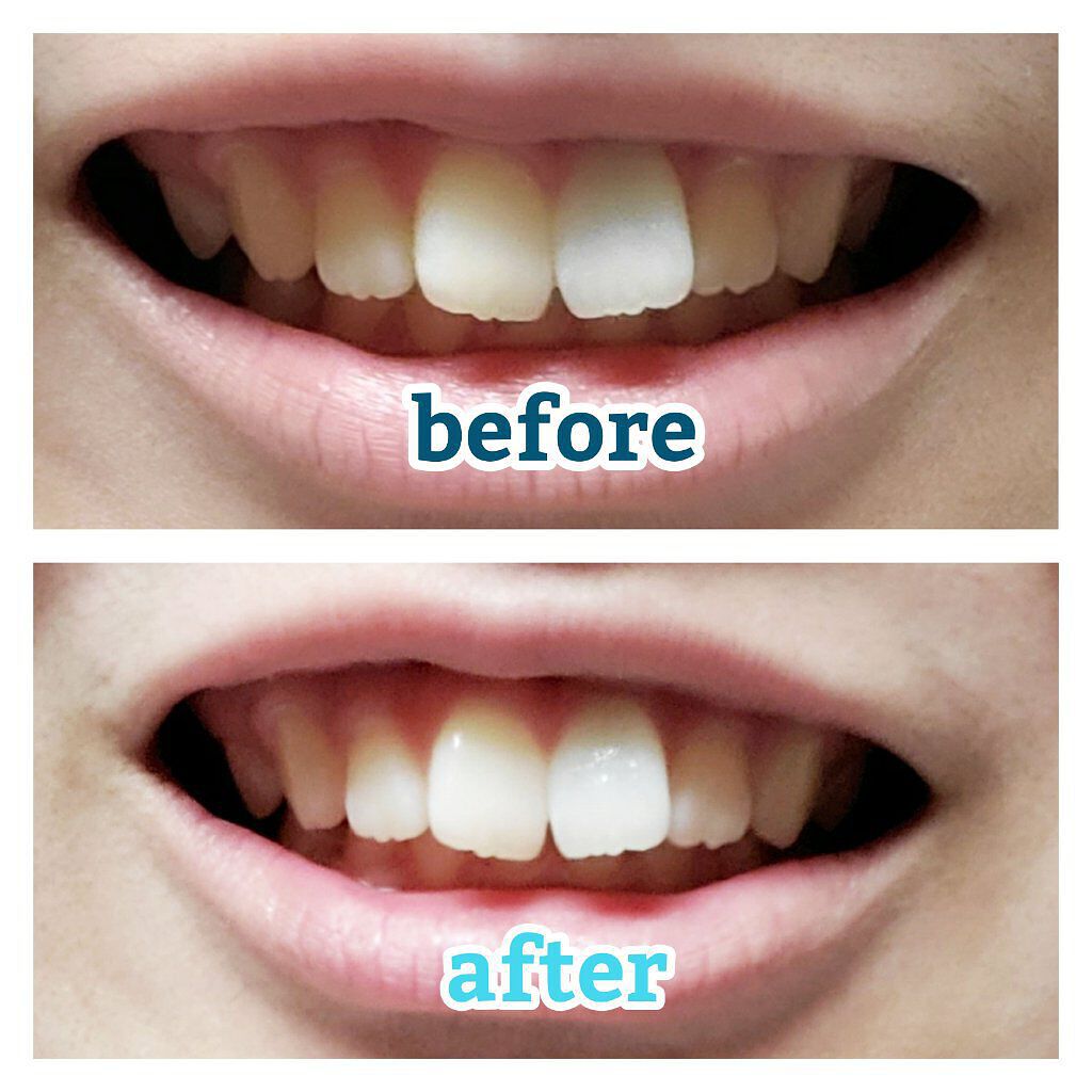 鈴華 on LIPS 「~歯で印象は変わる!!~マスクの時代だからこそ、マスクを取った..」(2枚目)