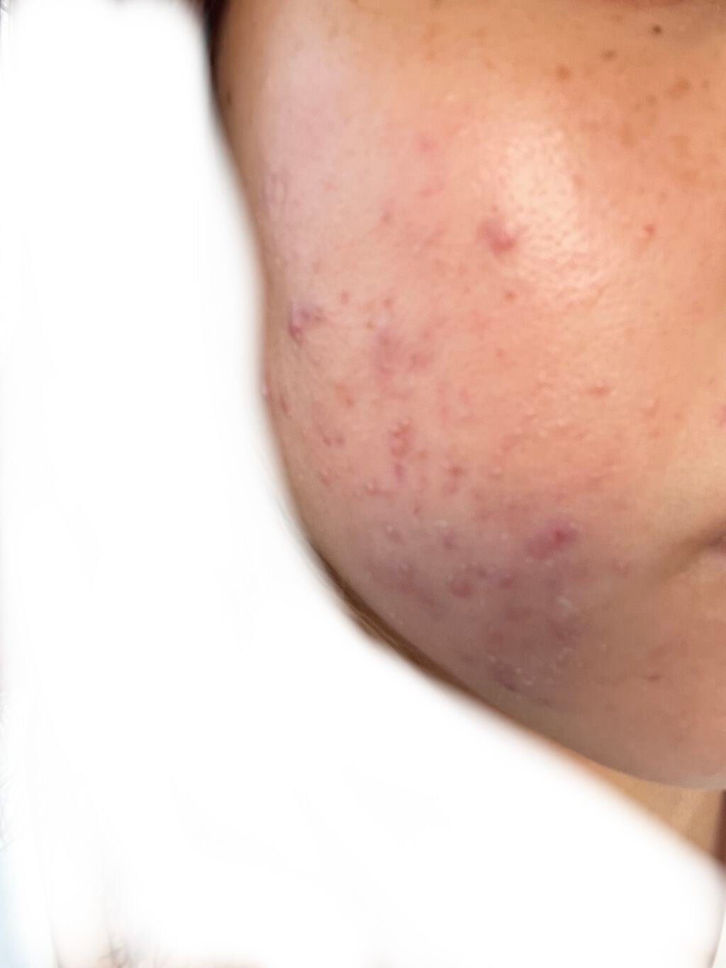 あめ on LIPS 「ゼビアックスの薬を塗ると皮?ポロポロむけてしまうんだけどこれは..」(1枚目)