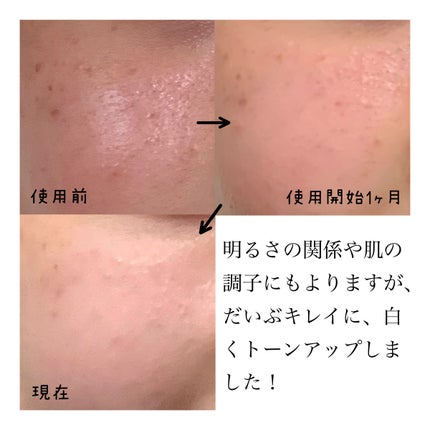 薬用しみ集中対策 プレミアム美容液/メラノCC/美容液を使ったクチコミ(5枚目)