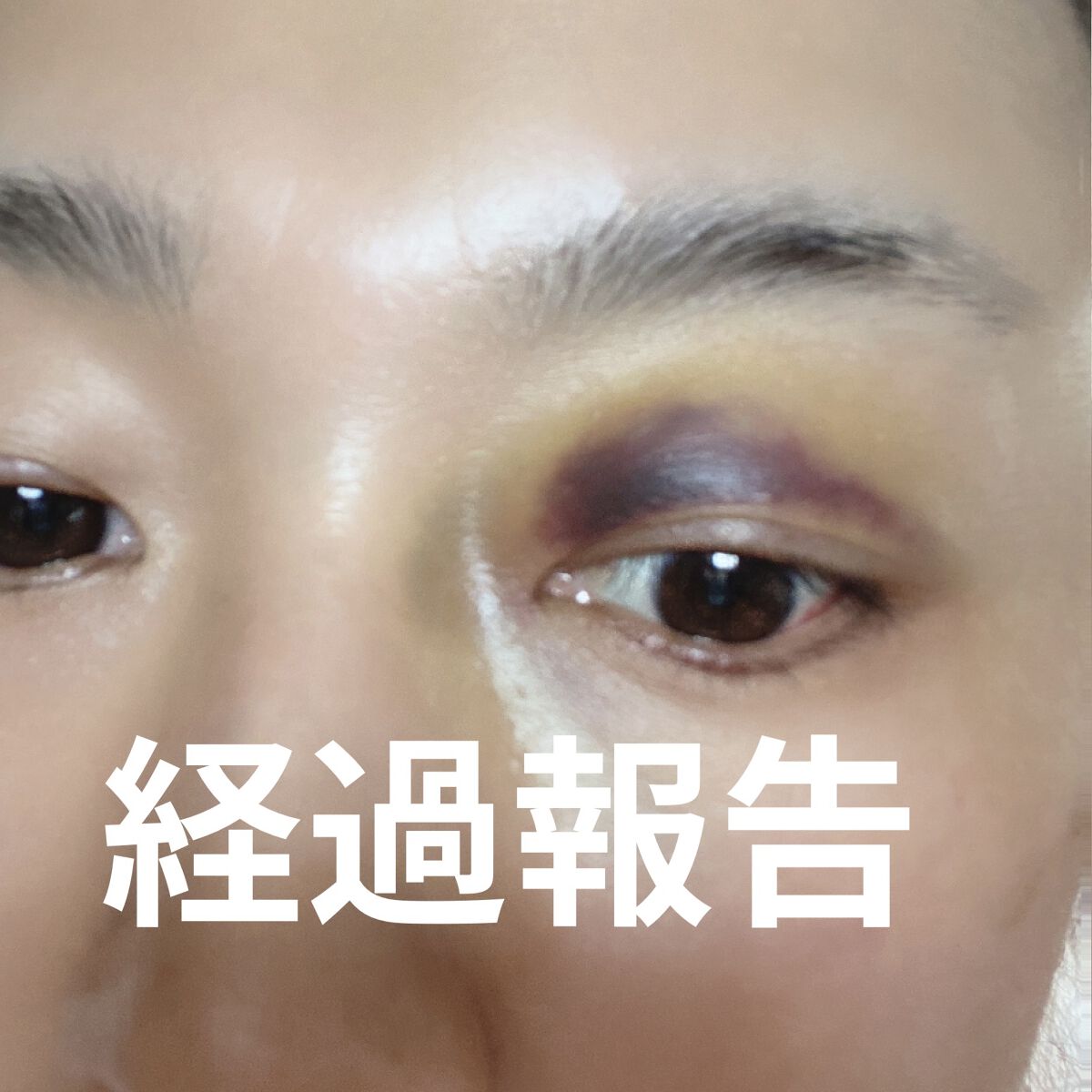 フーミー キニシーラー ナチュラルオレンジ/WHOMEE/パレットコンシーラーを使ったクチコミ（1枚目）