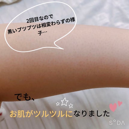 光脱毛器 VIO/Sarlisi/家庭用脱毛器を使ったクチコミ(2枚目)