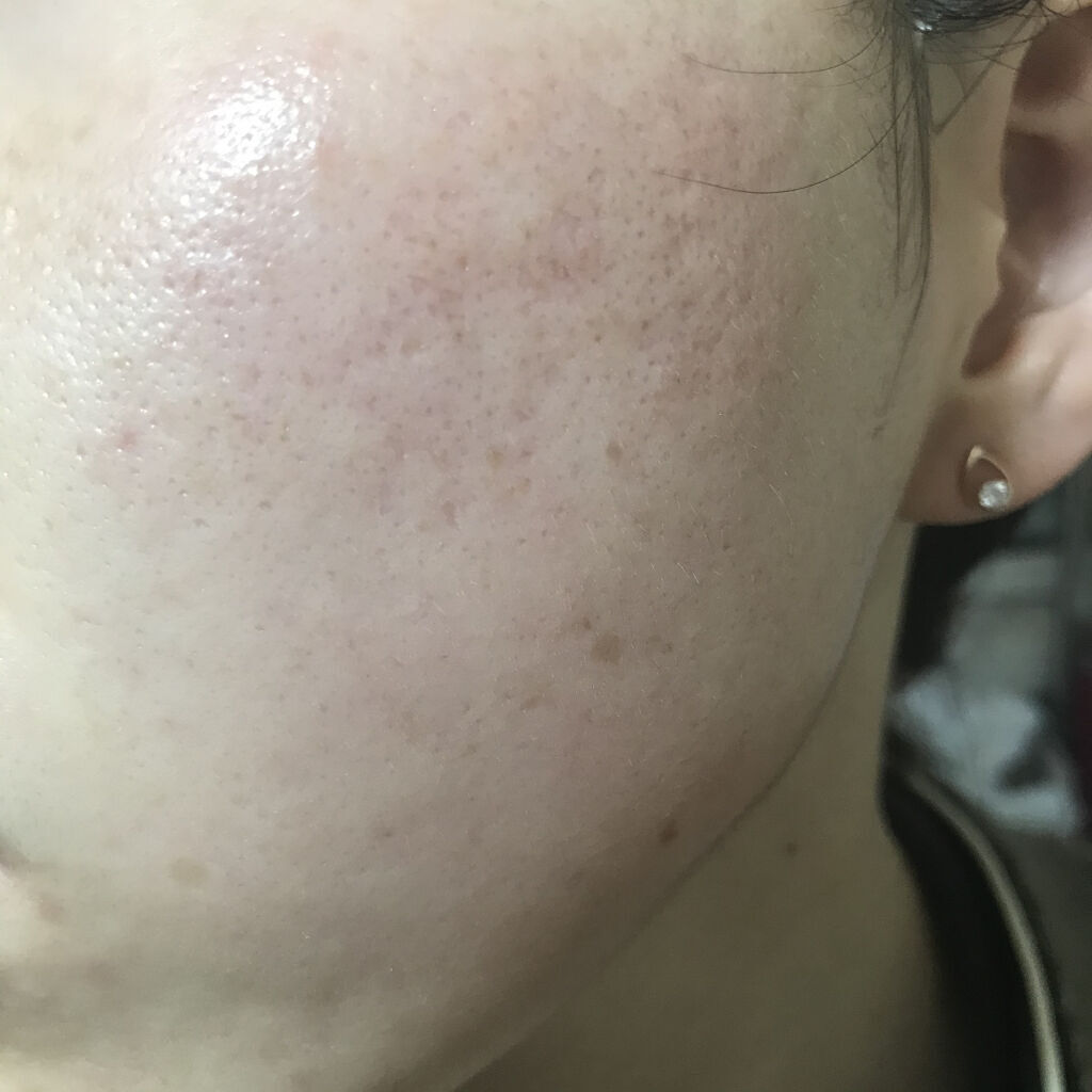 LA10+HAフェイスセラム/The Ordinary/ピーリングを使ったクチコミ（2枚目）