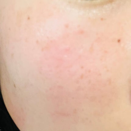 クリアパッチ/Angelab/にきびパッチを使ったクチコミ(4枚目)