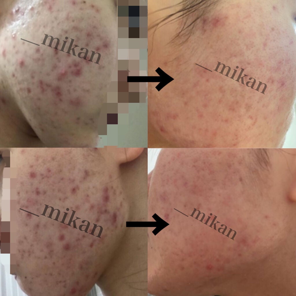 モイスチャージェル1/エンビロン/フェイスクリームを使ったクチコミ(2枚目)