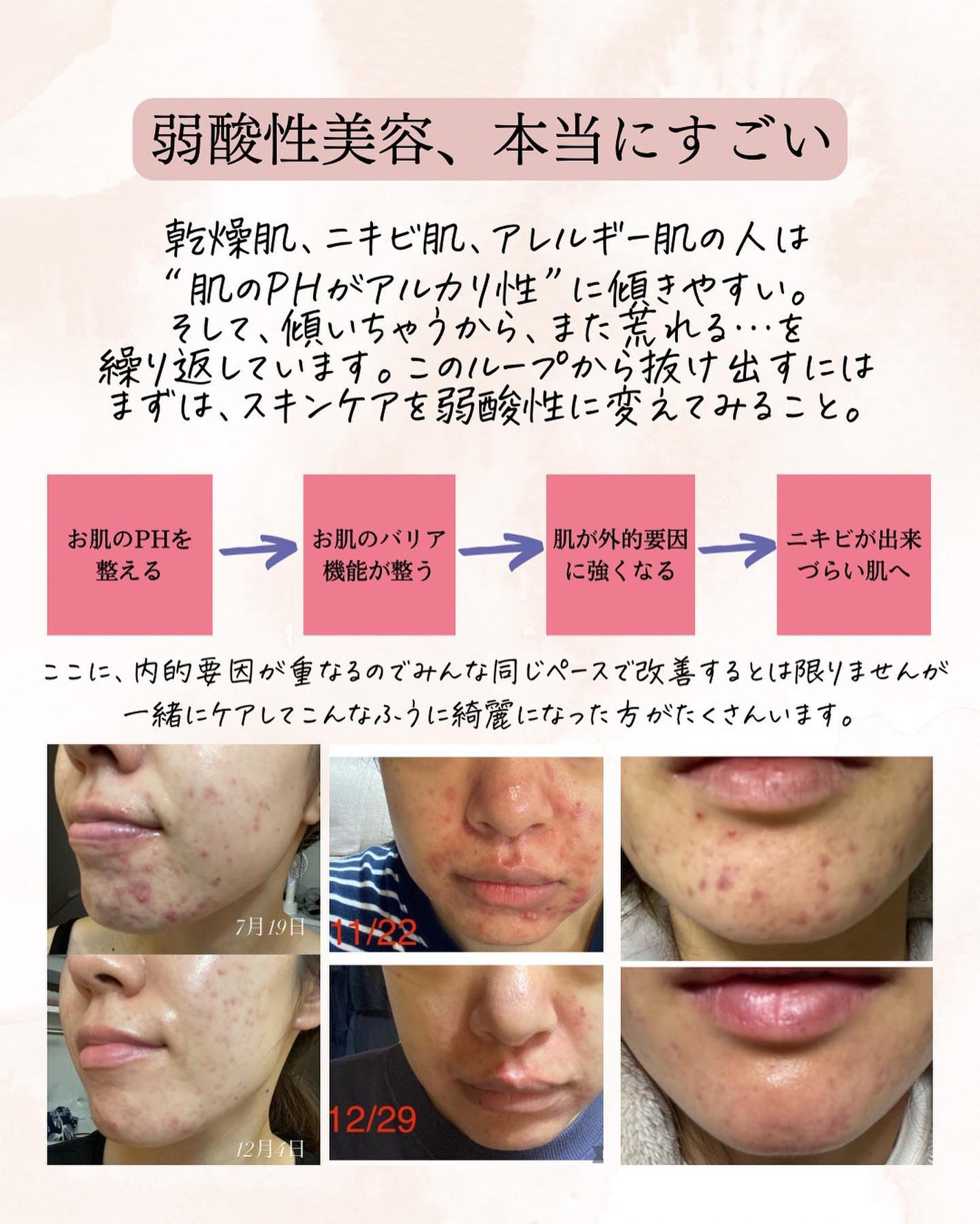 おゆみ|ニキビ・ニキビ跡ケア on LIPS 「@______ohyoume他の投稿はこちらから💁♀️【義務..」(5枚目)