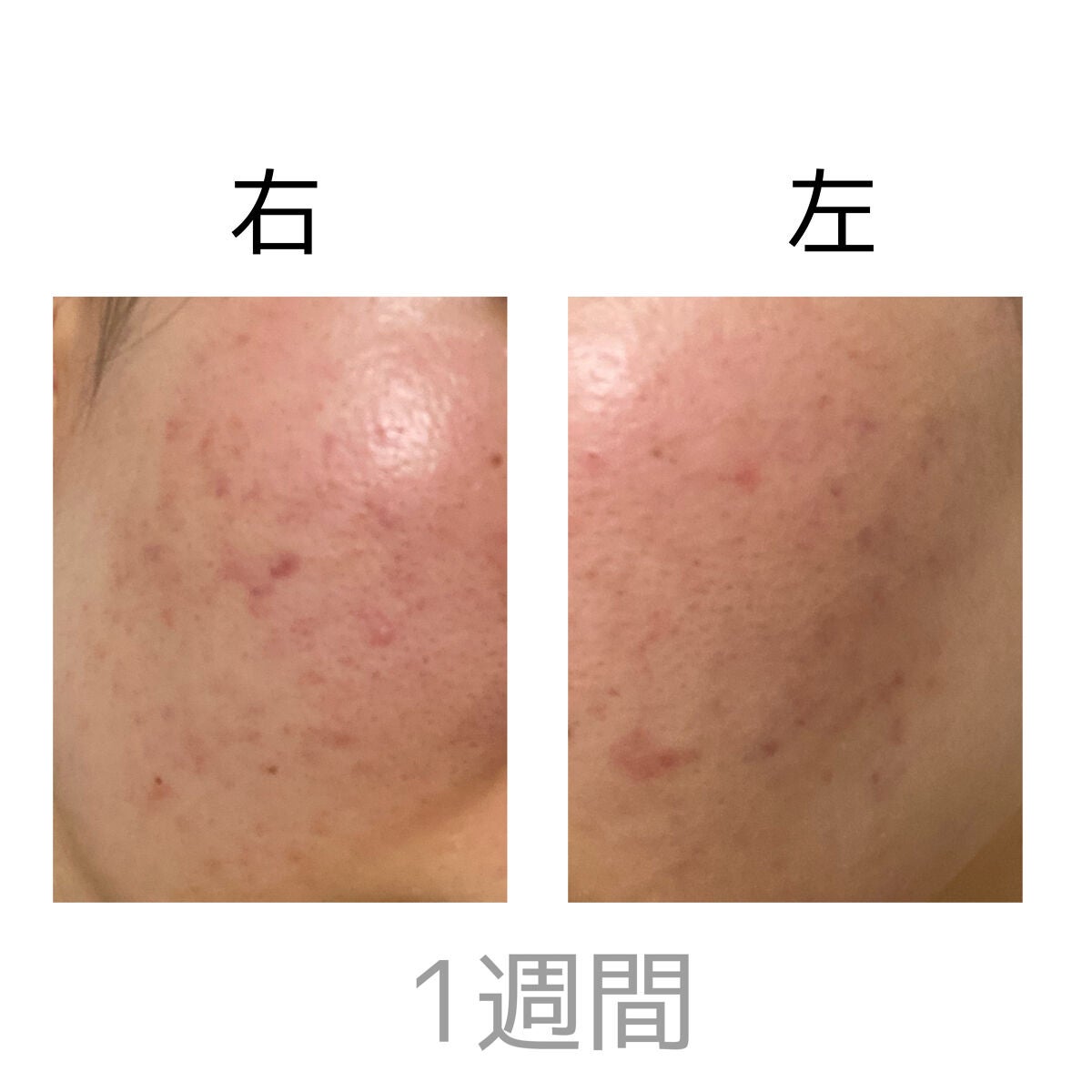 ゼロスポットパッチ/Today’s Cosme/にきびパッチを使ったクチコミ(4枚目)