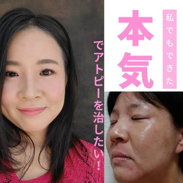 美肌カウンセラー💆綺麗のお助け相談所 on LIPS 「【本気でアトピーを治したい🧙‍♀️】心から願っているなら素直に..」（1枚目）