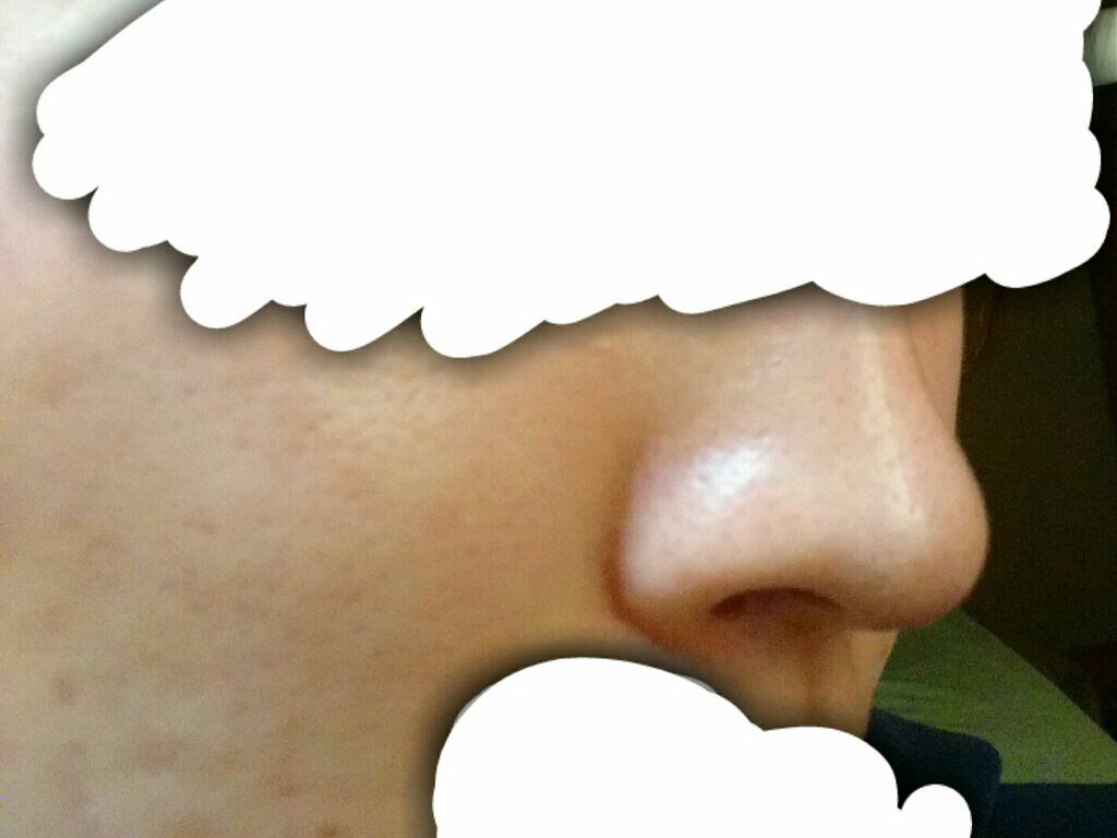 ベピオゲル/マルホ株式会社/その他を使ったクチコミ（2枚目）