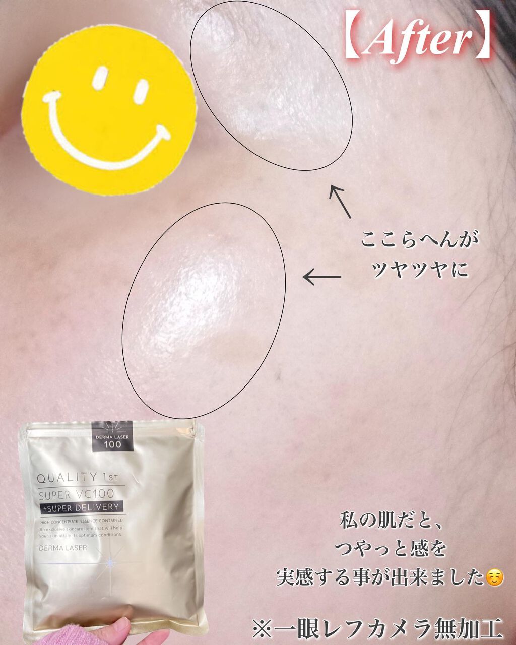 ダーマレーザースーパーVC100マスク/クオリティファースト/シートマスク・パックを使ったクチコミ(6枚目)