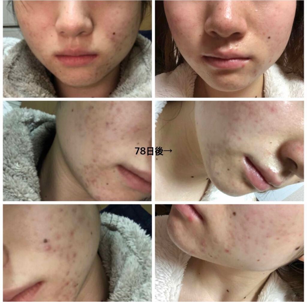 Moi on LIPS 「記録用一番初めのは過去アカウントから😅朝のスキンケア朝用サボリ..」(1枚目)