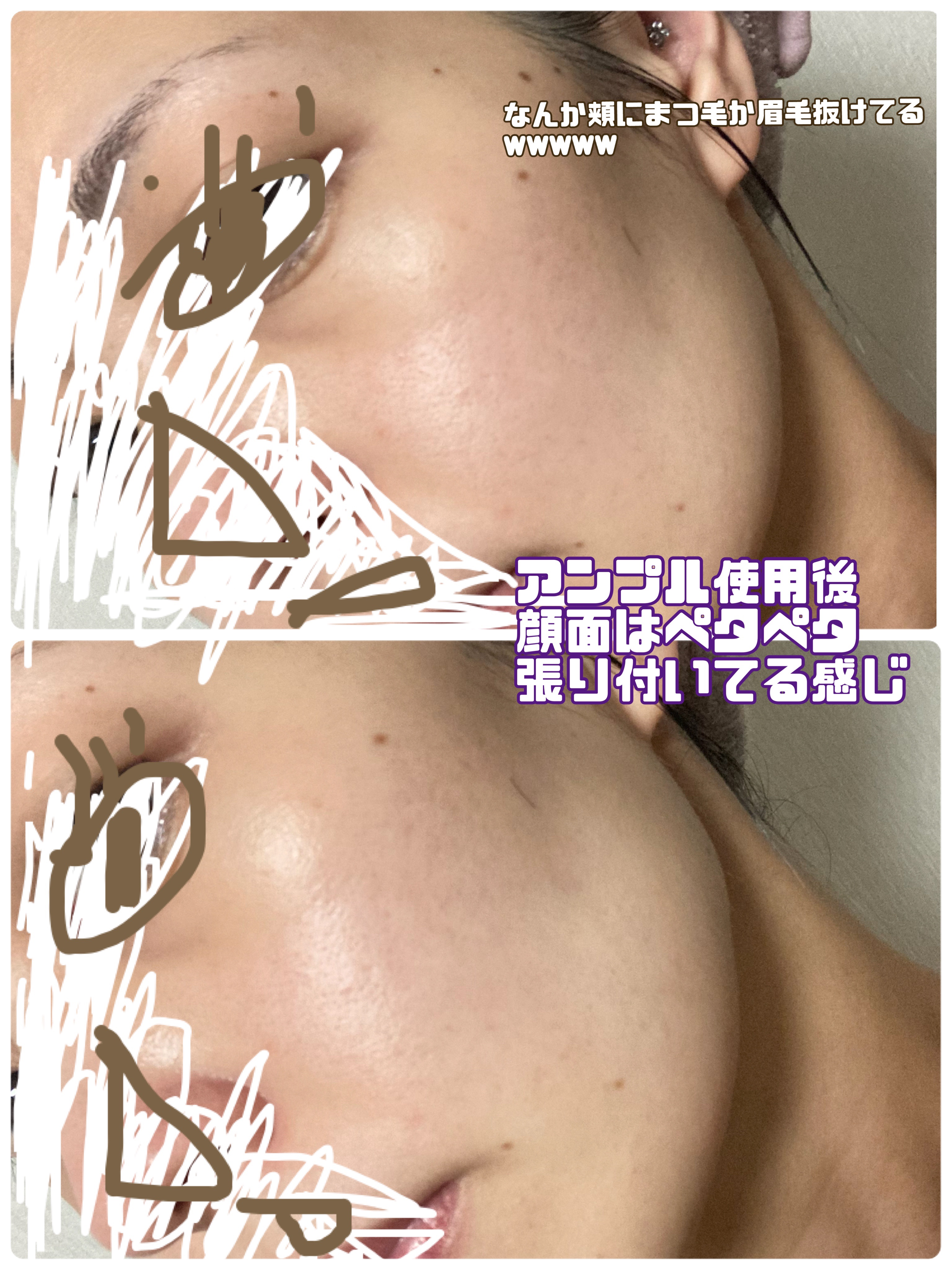 リマージ糸リフティングアンプル/REVENIP/美容液を使ったクチコミ（3枚目）