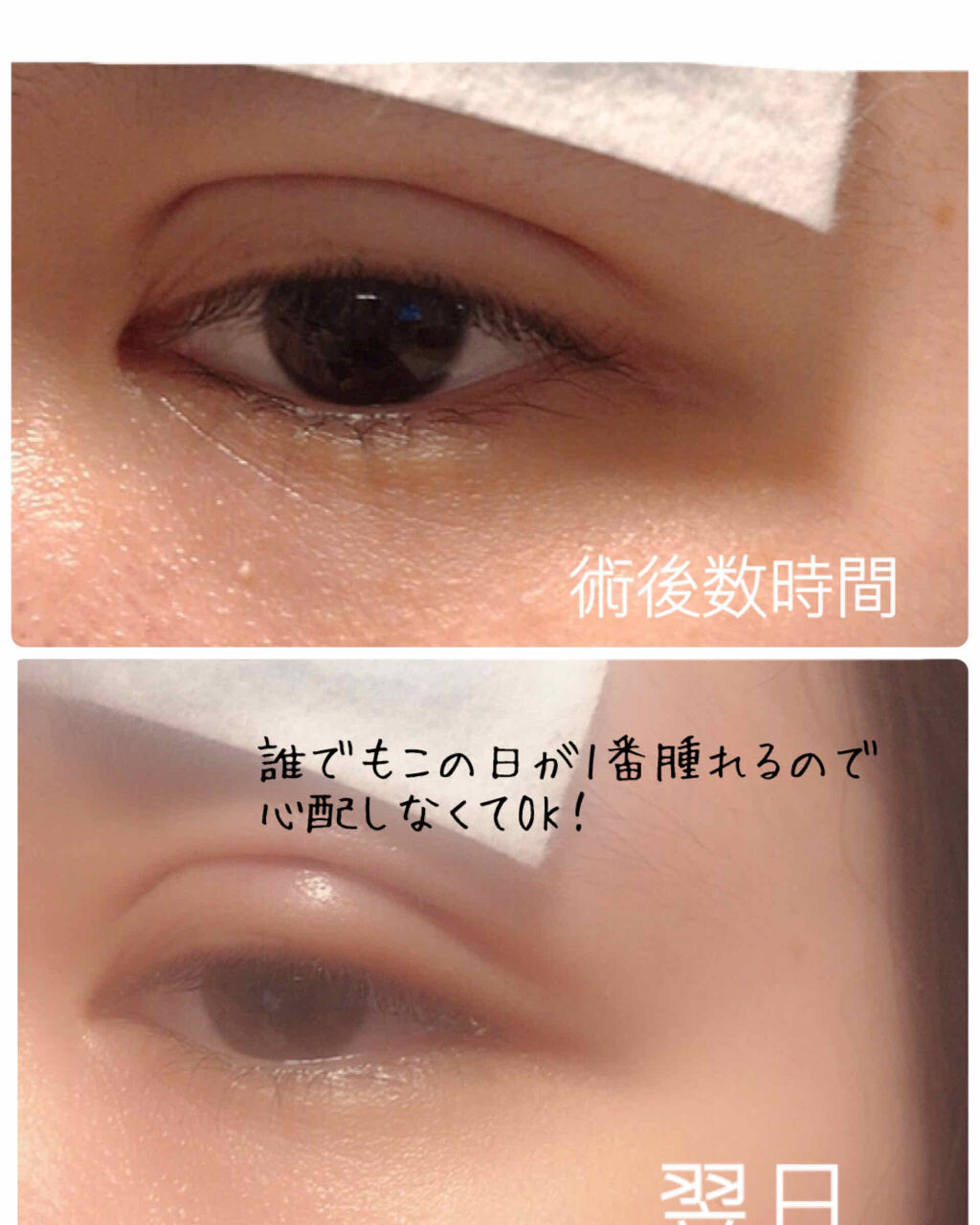 のびーるアイテープ（絆創膏タイプ、レギュラー）/DAISO/二重まぶた用アイテムを使ったクチコミ（2枚目）