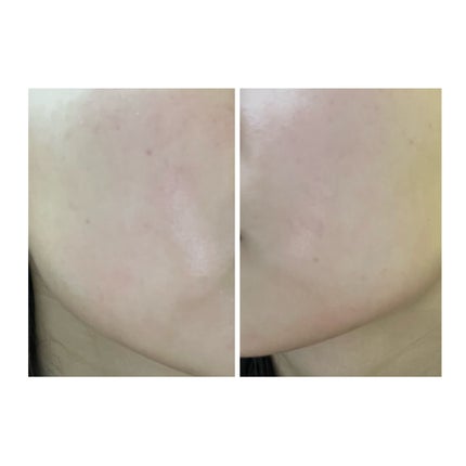 ぽむ on LIPS 「2023.9.13皮膚科に受診 エピデュオとヘパリン処方1枚目..」(5枚目)