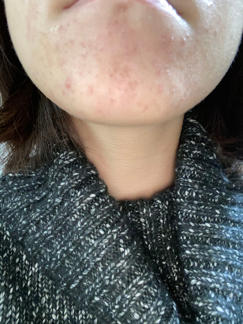 aya on LIPS 「お久しぶりです❕べピオゲル塗ってから1週間後...と言う話でし..」(4枚目)