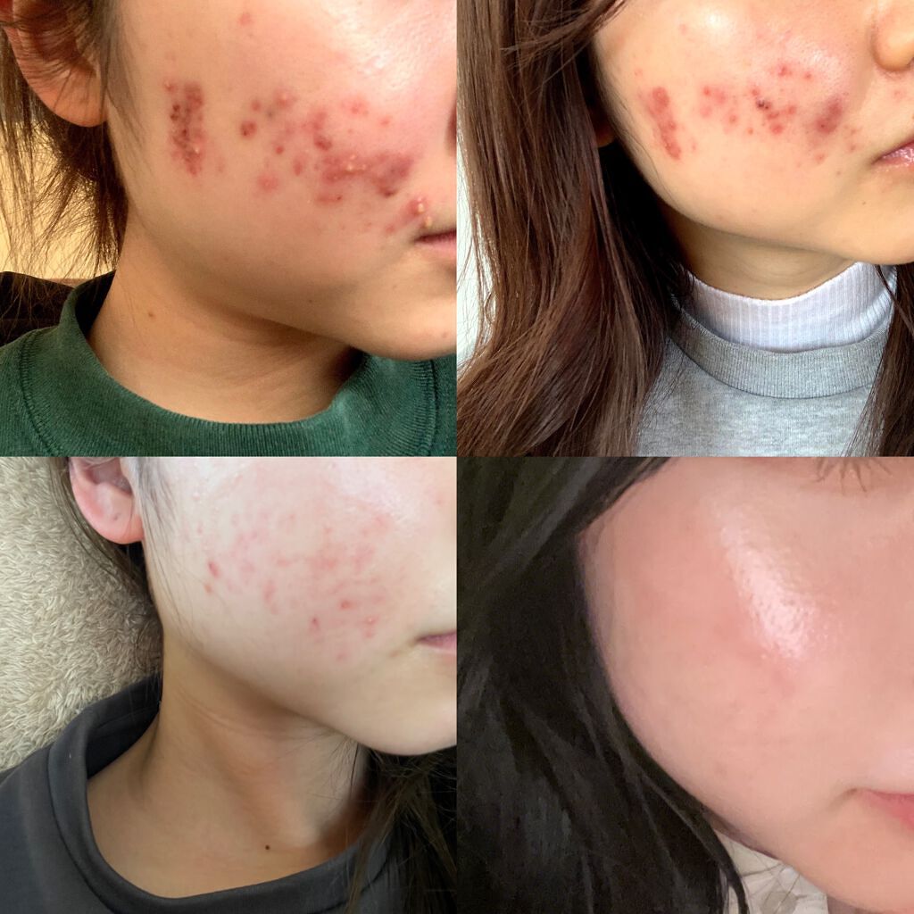 テラ・コートリル 軟膏(医薬品)/ジョンソン・エンド・ジョンソン/その他を使ったクチコミ(1枚目)