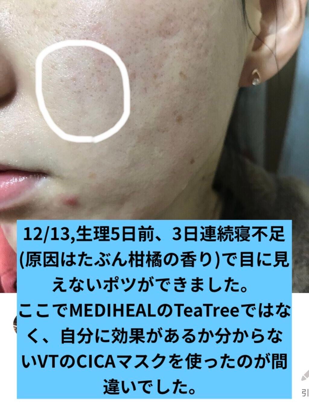 プロCICA クリアスポットパッチ/VT/その他スキンケアを使ったクチコミ(2枚目)