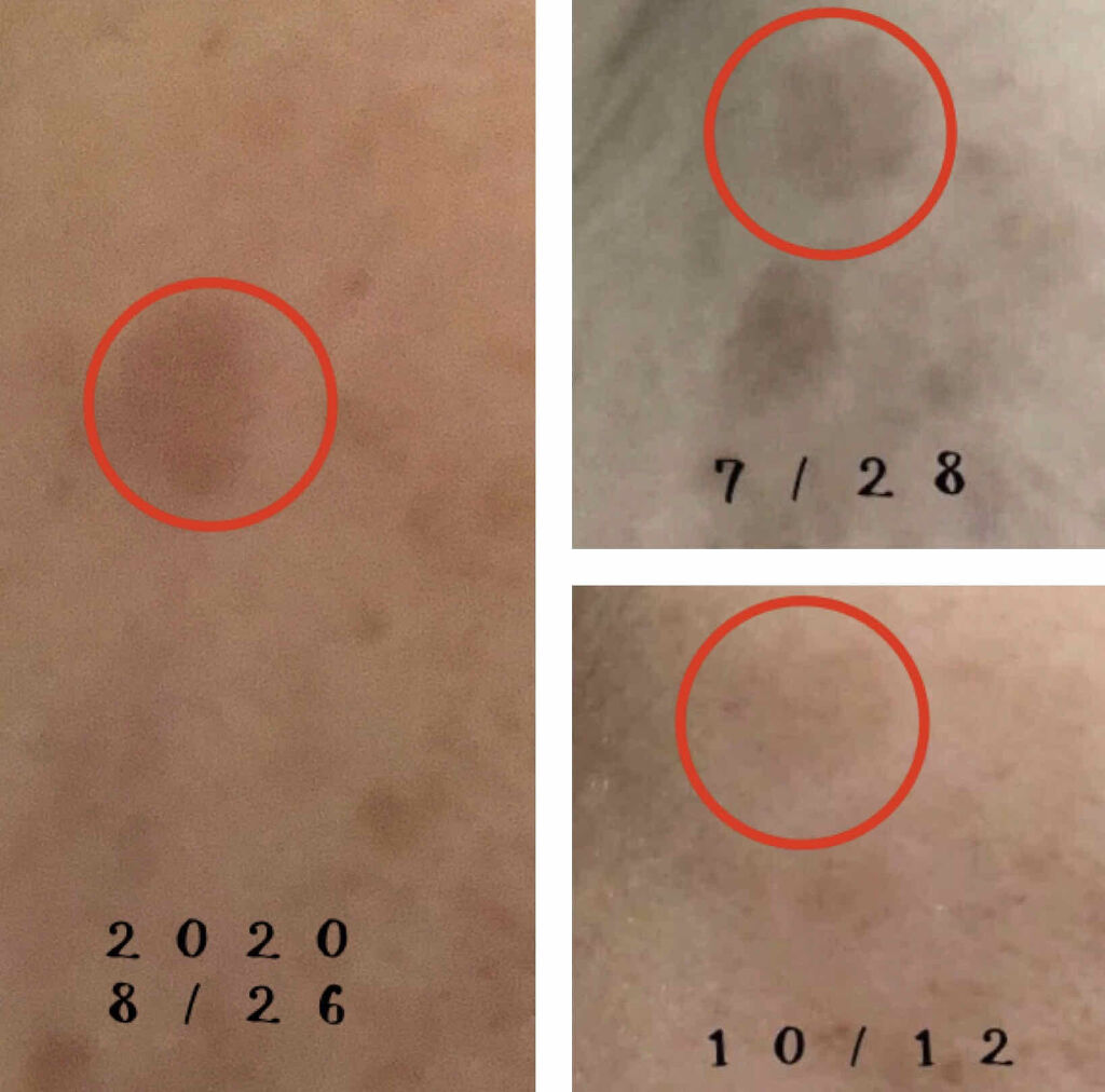 EUKROMA　ハイドロキノンクリーム4%　20g/EUKROMA/その他スキンケアを使ったクチコミ（3枚目）