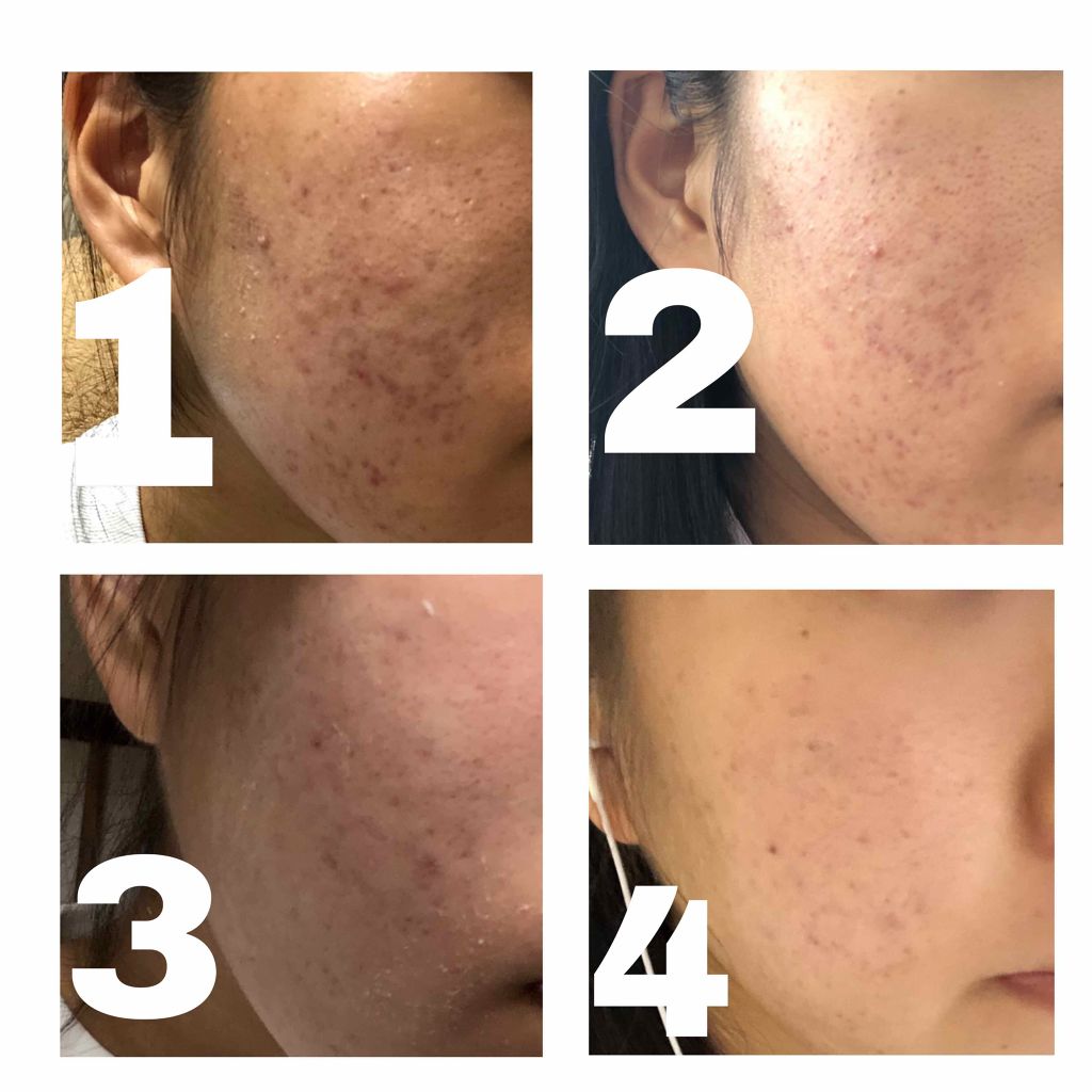 ロゼット洗顔パスタ アクネクリア/ロゼット/洗顔フォームを使ったクチコミ(4枚目)