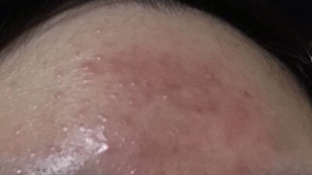 ティーツリーカーミングエッセンスパッド/MEDIHEAL/トナーパッドを使ったクチコミ（3枚目）