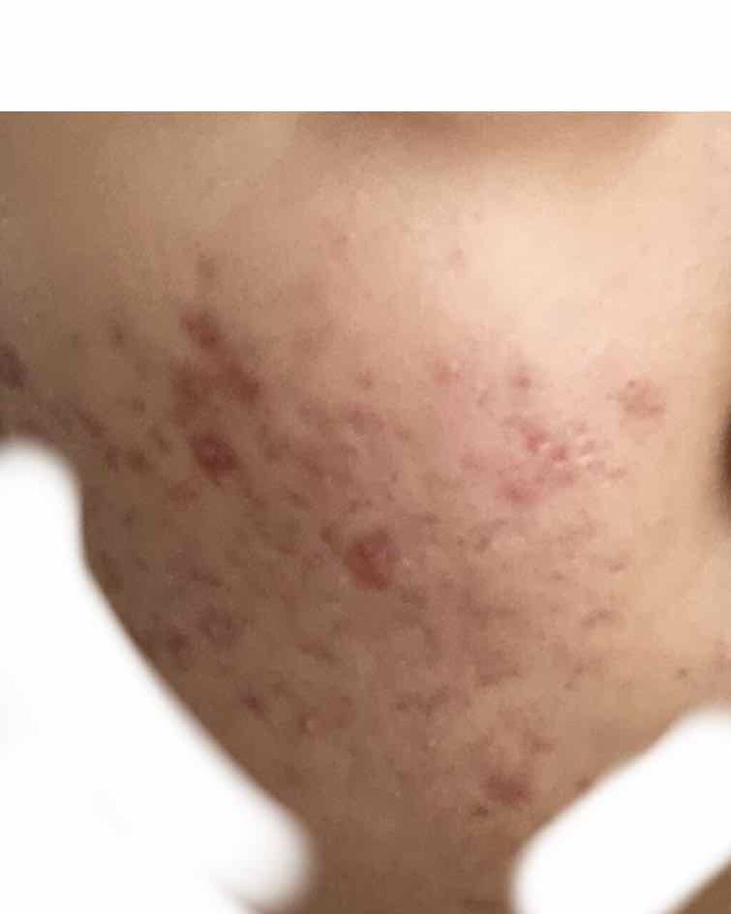 可愛くなりたい on LIPS 「記録赤く色素沈着したニキビ跡に効果ある洗顔や化粧水などあれば教..」(1枚目)