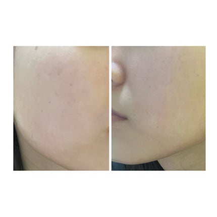 ぽむ on LIPS 「2023.9.13皮膚科に受診 エピデュオとヘパリン処方1枚目..」(5枚目)