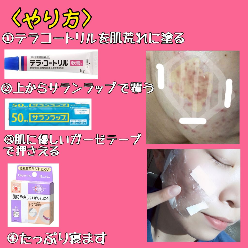 テラ コートリル 軟膏 医薬品 ジョンソン エンド ジョンソンの口コミ 私が最もニキビがひどかったときのお話 By ほたて 混合肌 代後半 Lips