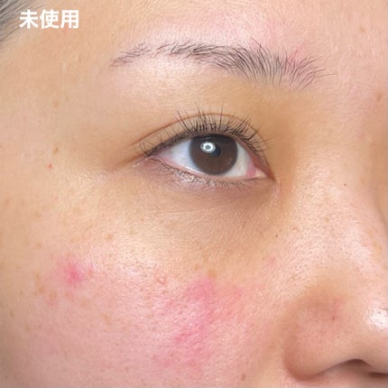 ACマグネシウムパッチ ミニ/スノーツープラス/にきびパッチを使ったクチコミ(7枚目)