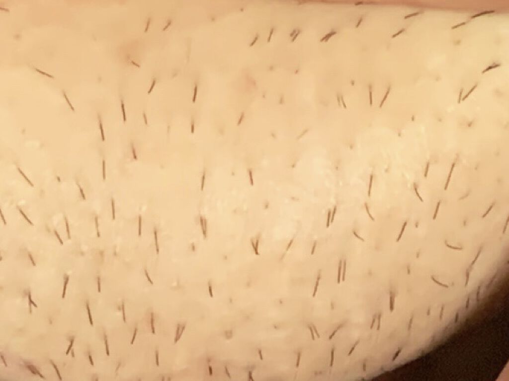 FASIZ607C IPL光脱毛器/FASIZ/家庭用脱毛器を使ったクチコミ（2枚目）