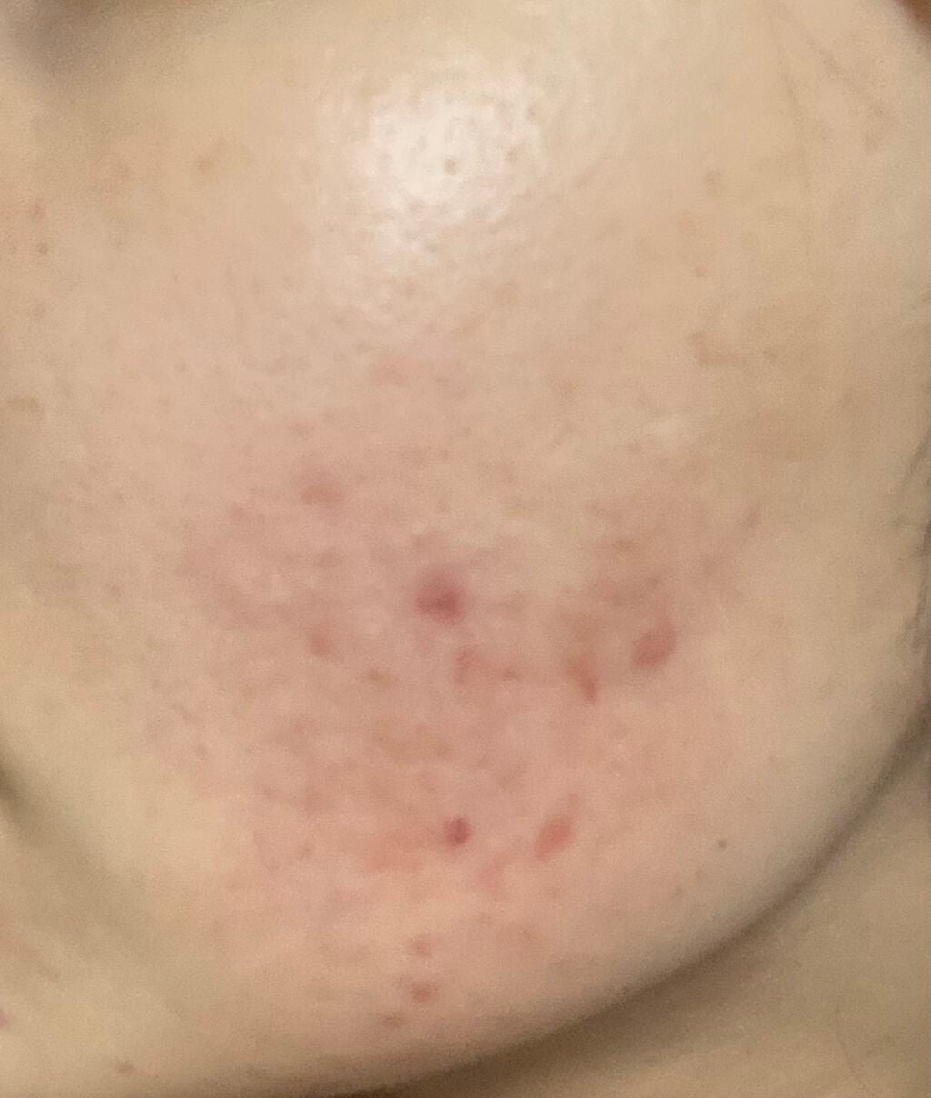 ra on LIPS 「7月7日仕事終わりのお風呂前の内カメでの撮影#ニキビ#ニキビ跡..」(2枚目)