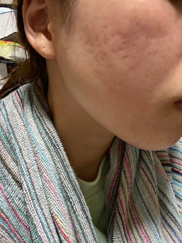 AHA 30% + BHA 2% Peeling Solution/The Ordinary/ピーリングを使ったクチコミ（2枚目）