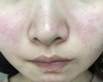 VC100エッセンスローション EX/ドクターシーラボⓇ/化粧水を使ったクチコミ(1枚目)