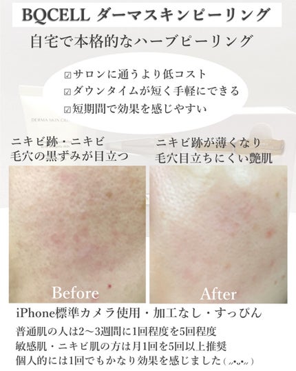 ダーマスキンピーリング/BQCELL/その他キットセットを使ったクチコミ(5枚目)