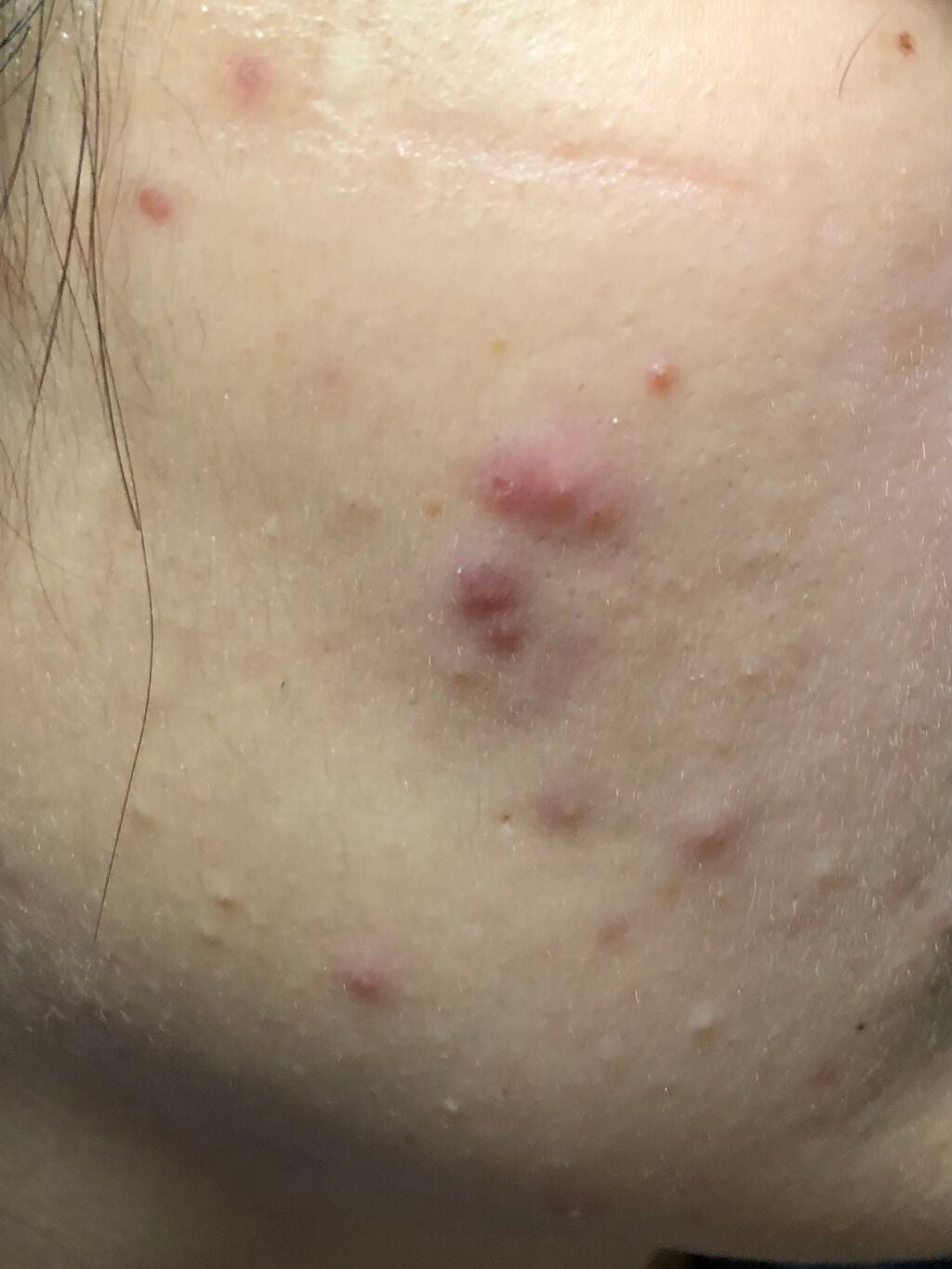 ちー on LIPS 「汚くてすいません。デュアック配合ゲルを2週間使用して、2.3日..」(1枚目)