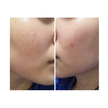 ぽむ on LIPS 「2023.9.13皮膚科に受診 エピデュオとヘパリン処方1枚目..」(5枚目)