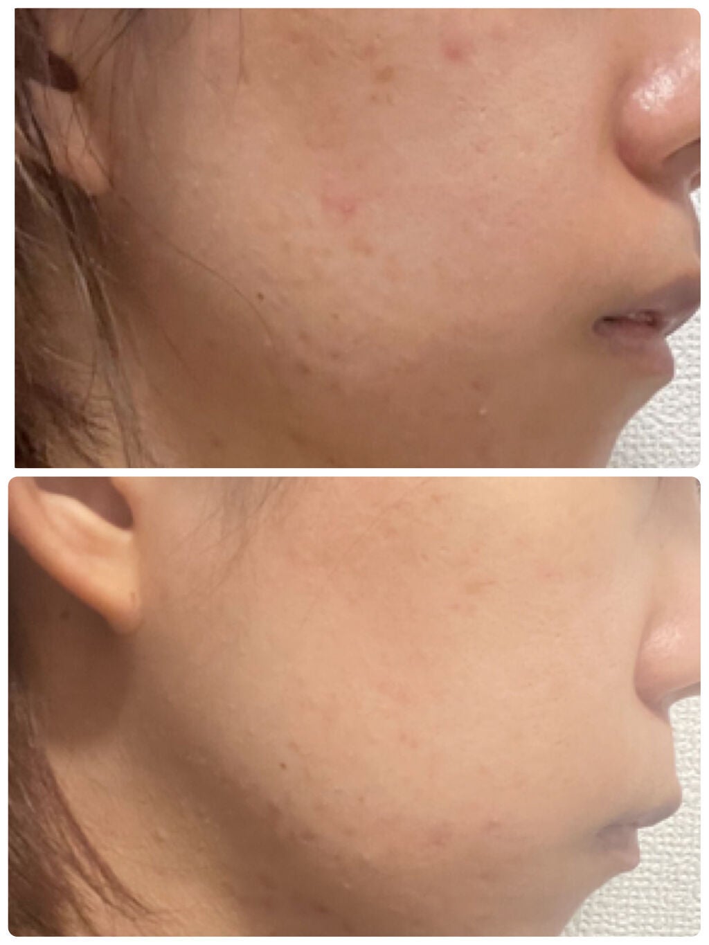 にちか on LIPS 「《使い切りレビュー》 ⚠️2枚目以降閲覧注意ニキビ治療薬 AP..」(2枚目)