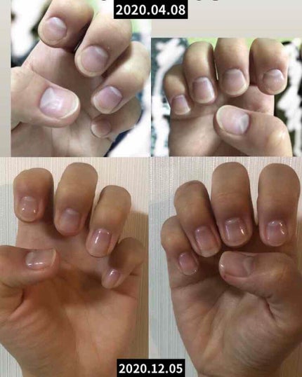 ネイルベッドオイル/アンドネイル/ネイルオイル・トリートメントを使ったクチコミ(1枚目)