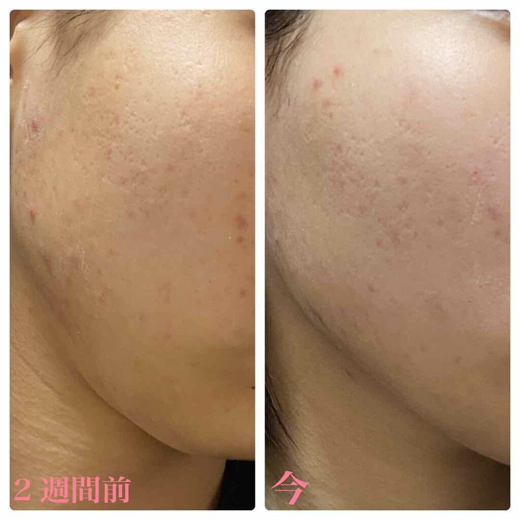 薬用しみ対策美白ジェル/メラノCC/フェイスクリームを使ったクチコミ（2枚目）