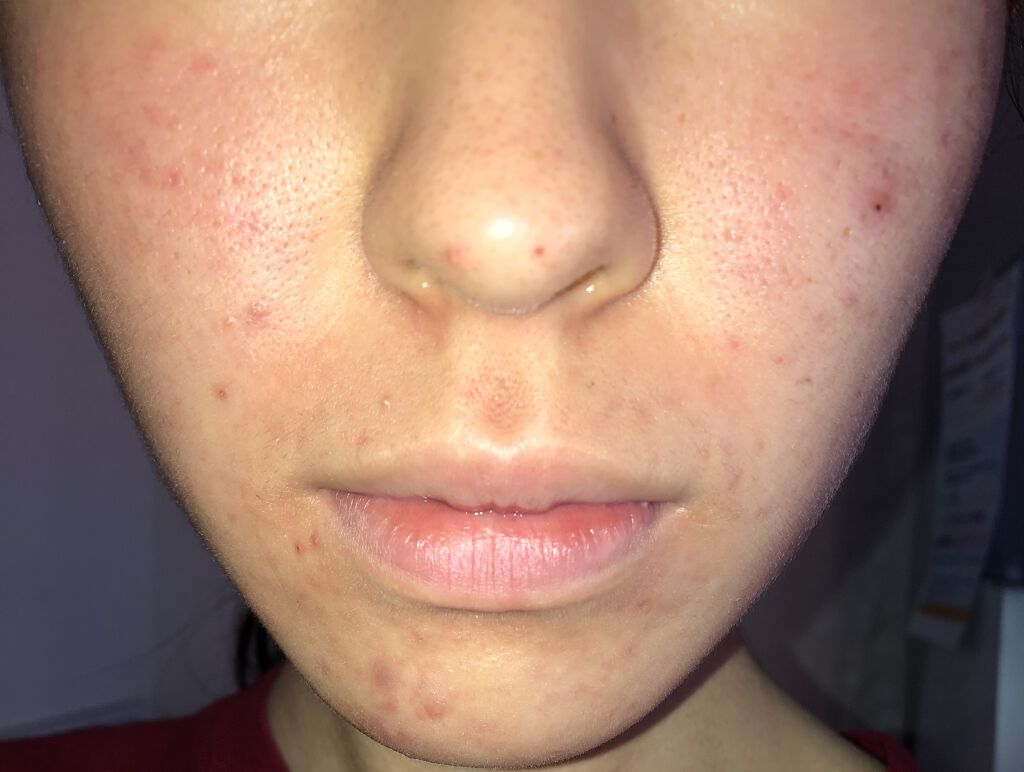 ノブ Ａ アクネソープ/NOV/洗顔石鹸を使ったクチコミ（3枚目）