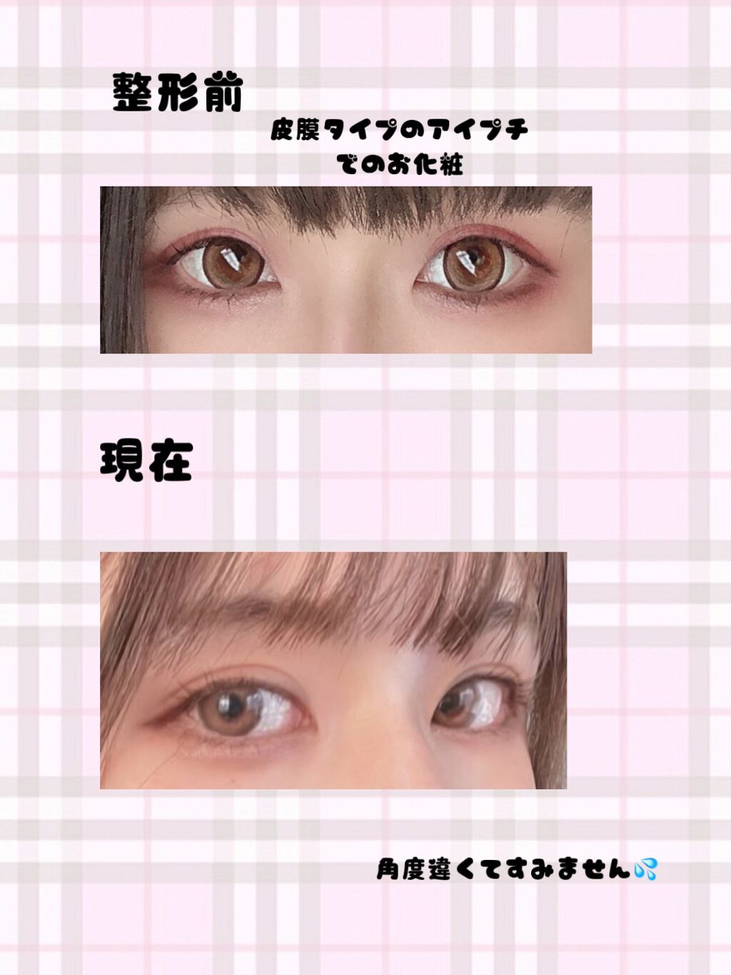 二重整形/その他を使ったクチコミ（2枚目）