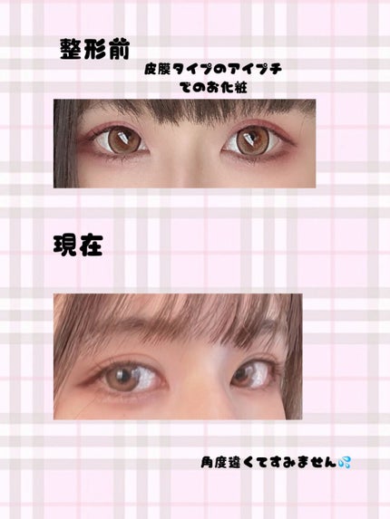 二重整形/その他を使ったクチコミ(2枚目)