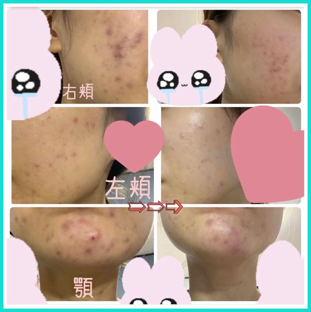 moo on LIPS 「先日品川スキンクリニックにてニキビ&ニキビ跡を治すためにカウン..」(1枚目)