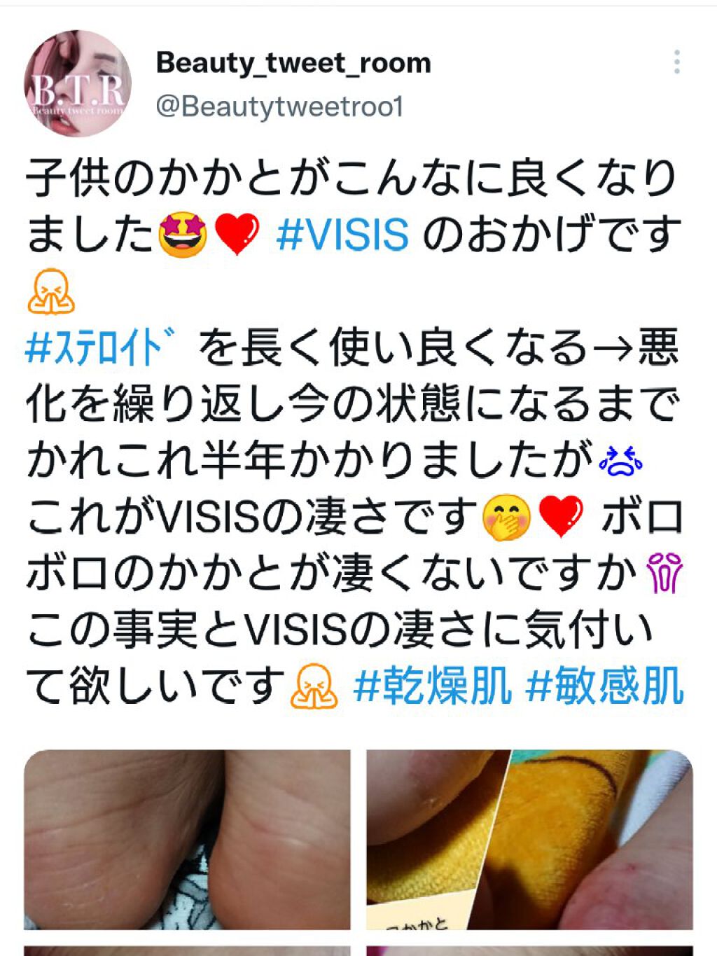 ❥ ❥ ❥ ru-ru-❥ ❥ ❥ on LIPS 「❤子供のトラブル肌改善❤少し時間かかりましたがこんなに良くなり..」(5枚目)
