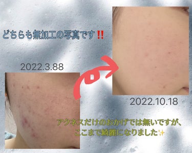 メンソレータム アクネス メンソレータムアクネス 薬用クリーム洗顔のクチコミ「ニキビ肌の人全員買って‼️‼️‼️


こんにちは☺️今回はニキビ肌の私が今まで使ってきた洗顔.....」（3枚目）