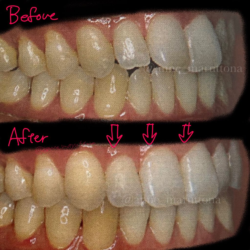 matsukiyo 歯間ブラシ のクチコミ「\矯正治療体験記/

#歯列矯正
#矯正治療
#矯正

矯正治療を受けたことがあります。
悩ん.....」（3枚目）