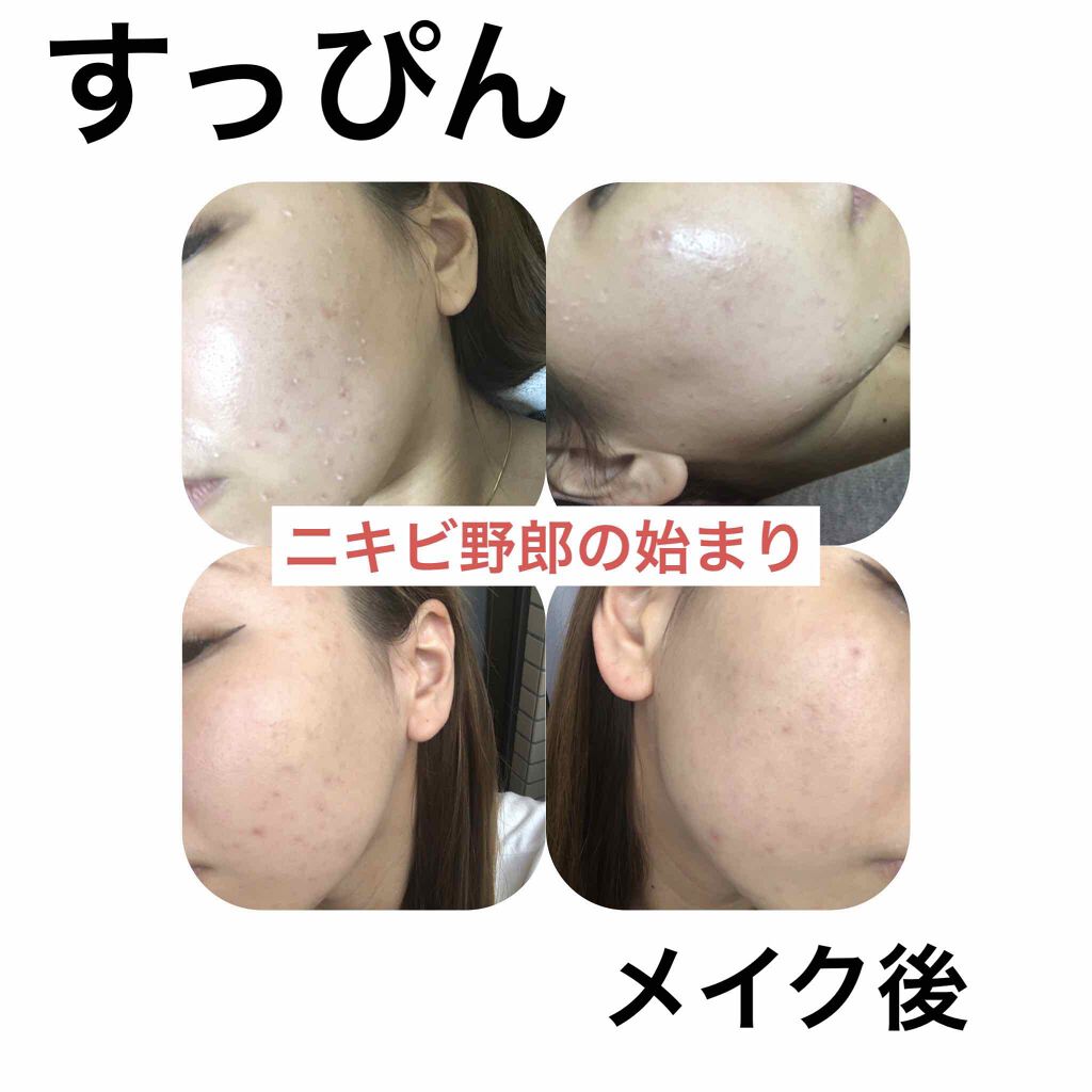 ニョッキ on LIPS 「私の小人さん(ニキビ)の始まりは小学5.6年生。もう顔面小人だ..」(1枚目)