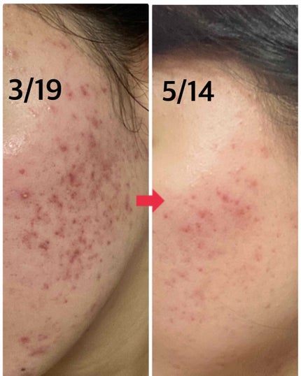 ロゼット洗顔パスタ アクネクリア/ロゼット/洗顔フォームを使ったクチコミ(1枚目)