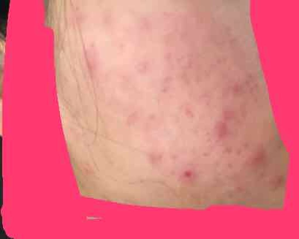 ノブ Ａ アクネソープ/NOV/洗顔石鹸を使ったクチコミ（3枚目）