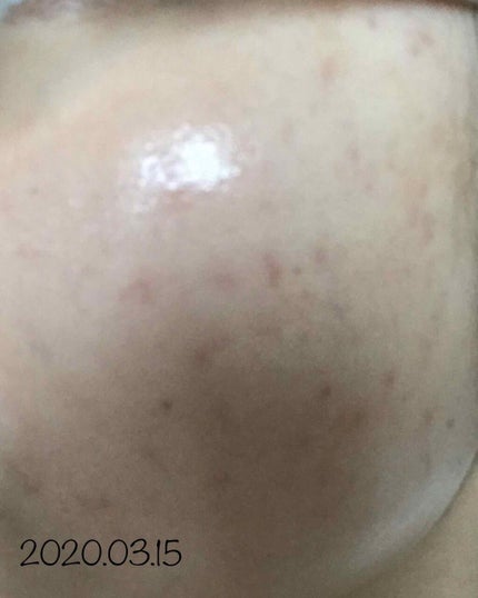 ダラシンTゲル 1% (医薬品)/佐藤製薬/その他を使ったクチコミ(2枚目)