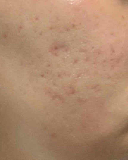 肌荒れマン on LIPS 「お久しぶりです!!約5ヶ月ぶりに書きます❕❕まず、写真について..」(4枚目)